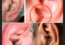 🚨BE CAREFUL, If you spot these dots on your skin, it means you have Ca…