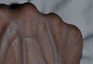 If you have these visible veins in your hand it’s a sign of can…See more
