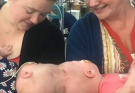 🎥These sisters entered the world conjoined at the head 😲. Separating them was an incredibly complex surgery, as doctors had to divide not just their skulls but also brain tissue 😧. At only 10 months old, they faced this risky operation — and miraculously, it was a success 🌟. Today, at 9 years old, the girls are thriving. Although their growth is a bit different from other kids their age, they enjoy life just like anyone else 💕. Curious to see how they look now?